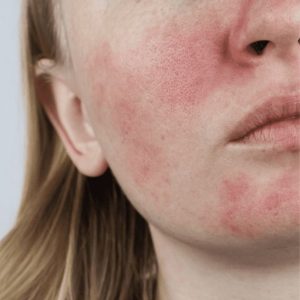 اصلاح مشکلات پوستی با مزاج شناسی