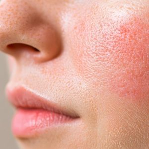 اصلاح مشکلات پوستی با مزاج شناسی